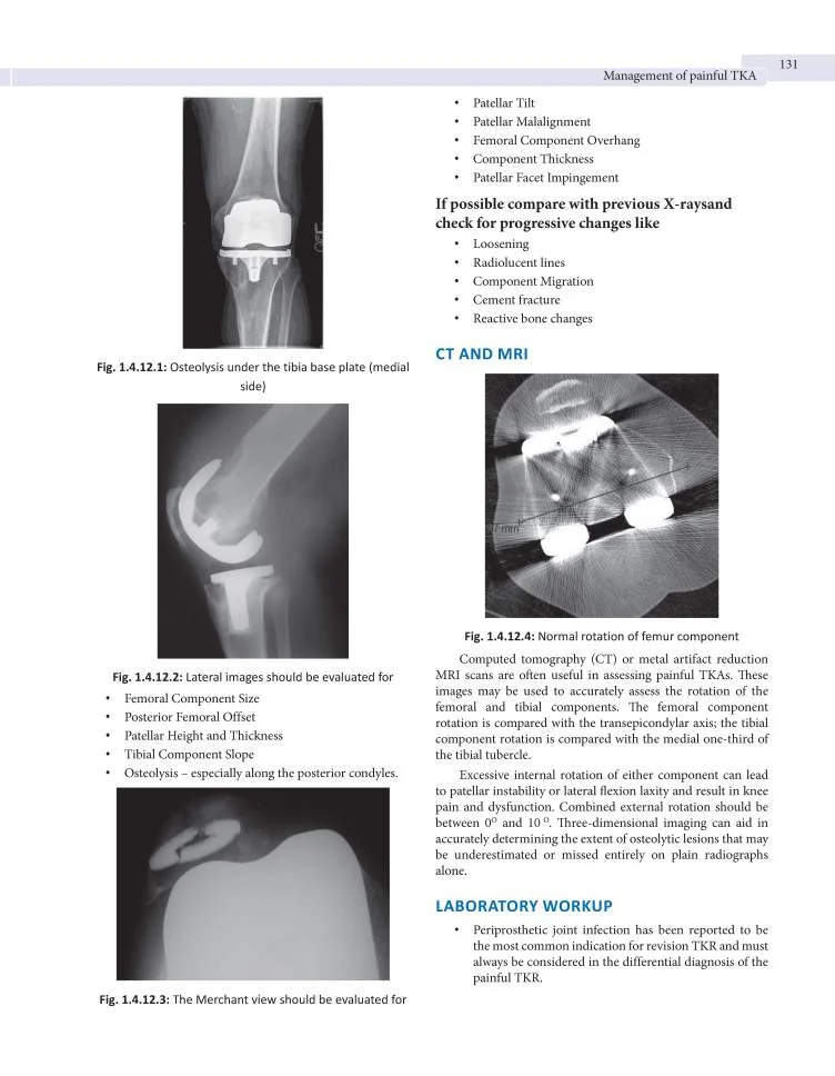 Arthroplasty-4